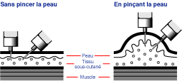 Technique sous-cutan�e
